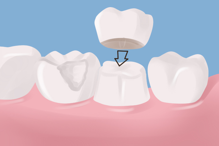 What is a Dental Crown?